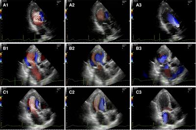 Flow dynamic assessment of native mitral valve, mitral valve repair and mitral valve replacement using vector flow mapping intracardiac flow dynamic in mitral valve regurgitation